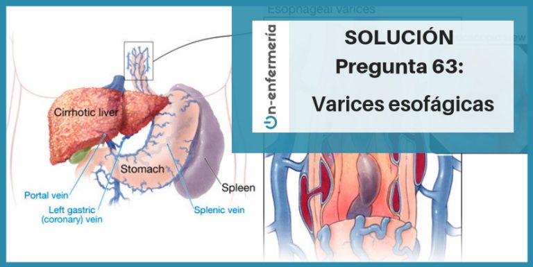 varices esogagicas